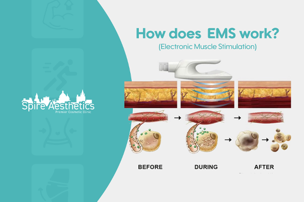 EMS treatment for post pregnancy weight loss treatment Barnsley