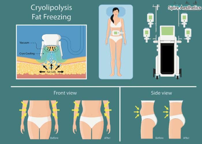 Image of diet and fat freezing combined for best results for Spire Aesthetics Barnsley