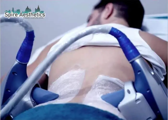 Man having fat freezing treatment done on love handles before a competitions Barnsley to create a sculpted look.