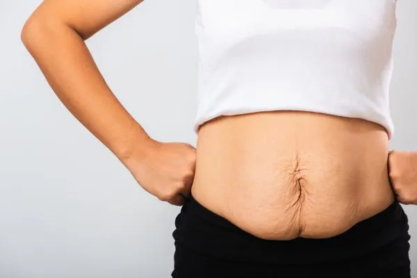 Image of a woman's stomach after weight loss with sagging skin following a gastric band Barnsley