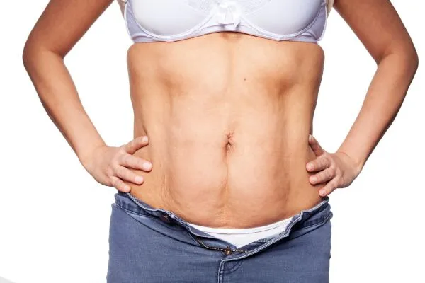 sagging skin on woman's stomach after weight loss injections Barnsley