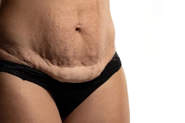 Image of womans stomach after weight loss injections Barnsley showing saggy skin
