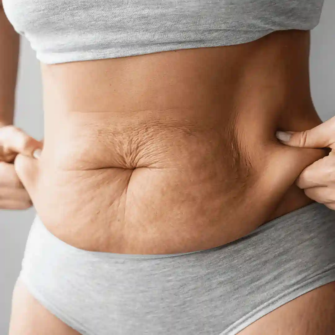 Is It Normal to Have Loose Skin After Pregnancy Barnsley?